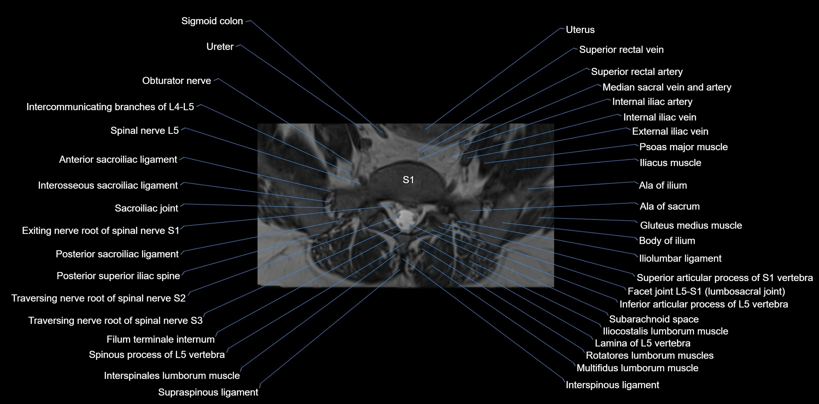 MRI sacrum, coccyx and sacroiliac joint axial cross sectional anatomy 3T  radiology  image-img-00001-00009.webp
